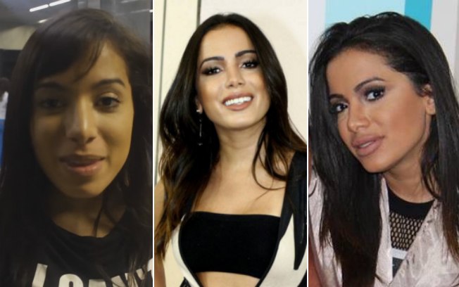 Anitta chamou a atenção depois de aparecer irreconhecível com preenchimento labial. Relembre outros famosos que exageraram nas plásticas